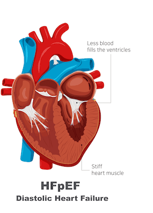 HFpEF Diastolic Heart Failure
